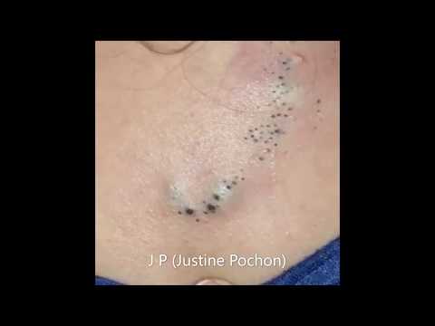 Video: Pimples Häpyhuulilla