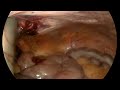 2 tubes interring a Gallbladder( part 2) unedited.