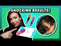 Blood Work and Hair Loss (Thriva blood test hair loss diagnosis + anti-hair loss action plan)