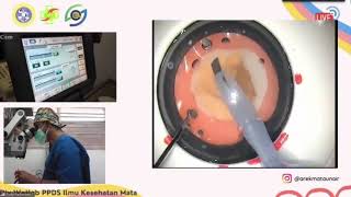 Step by step phacoemulsification wetlab PPDS Ilmu Kesehatan Mata Unair