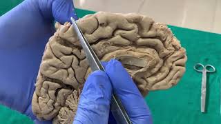 Dissection- Sulci & Gyri on Medial surface of brain