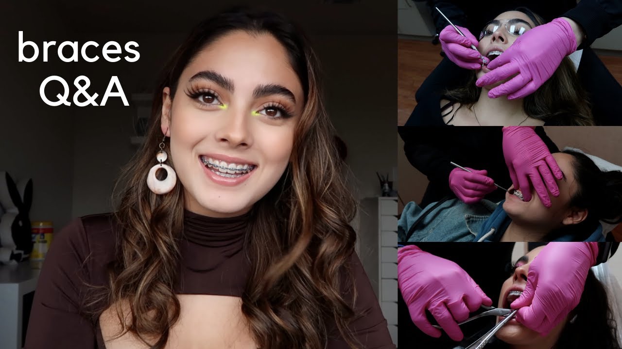 BRACES Q&A (cost, pain, experience, extractions + everything else you