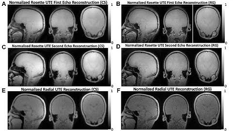 Myelin Imaging Using 3D Dual-echo Ultra-short Echo Time MRI with Rosette k-Space Pattern