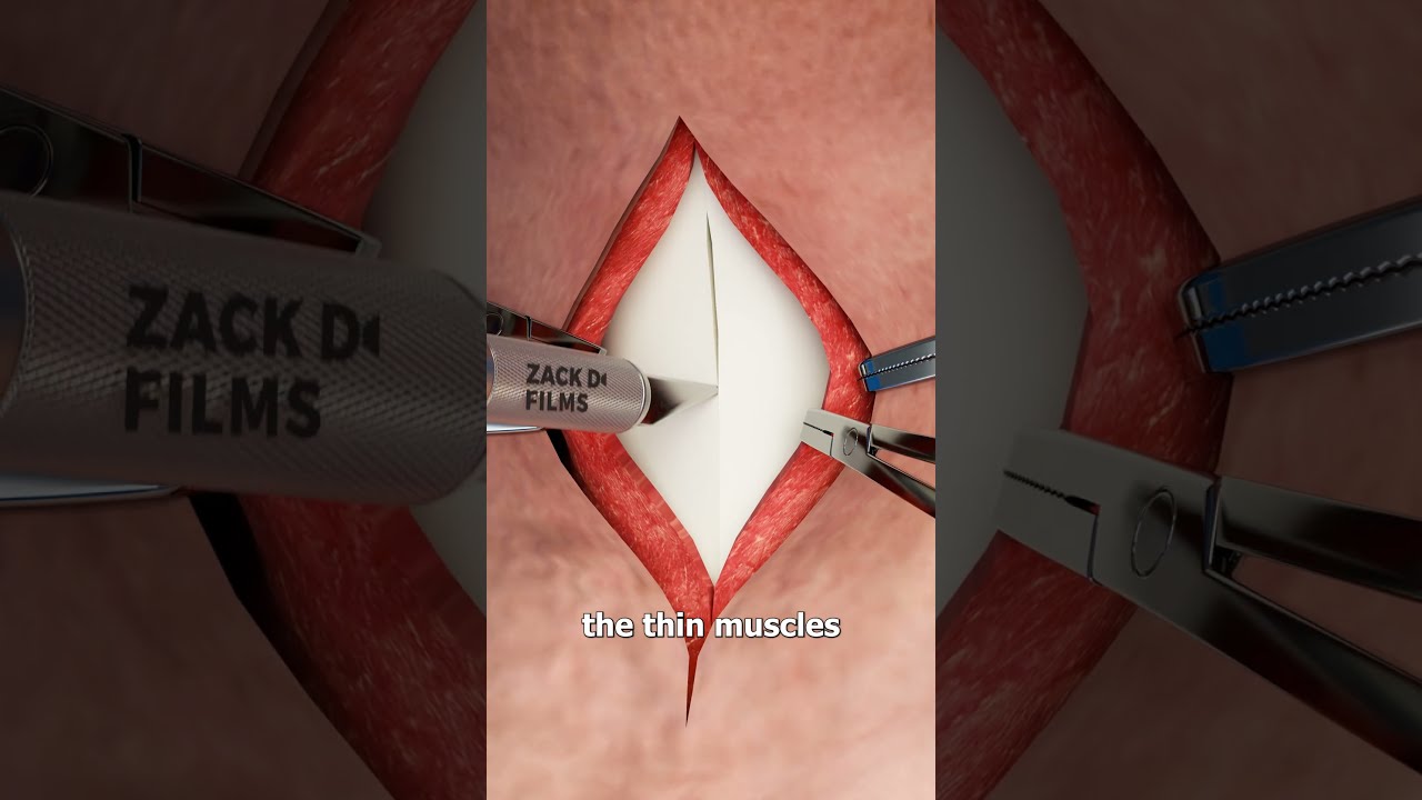 What Happens During A Tracheotomy 