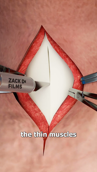 What Happens During A Tracheotomy 💉