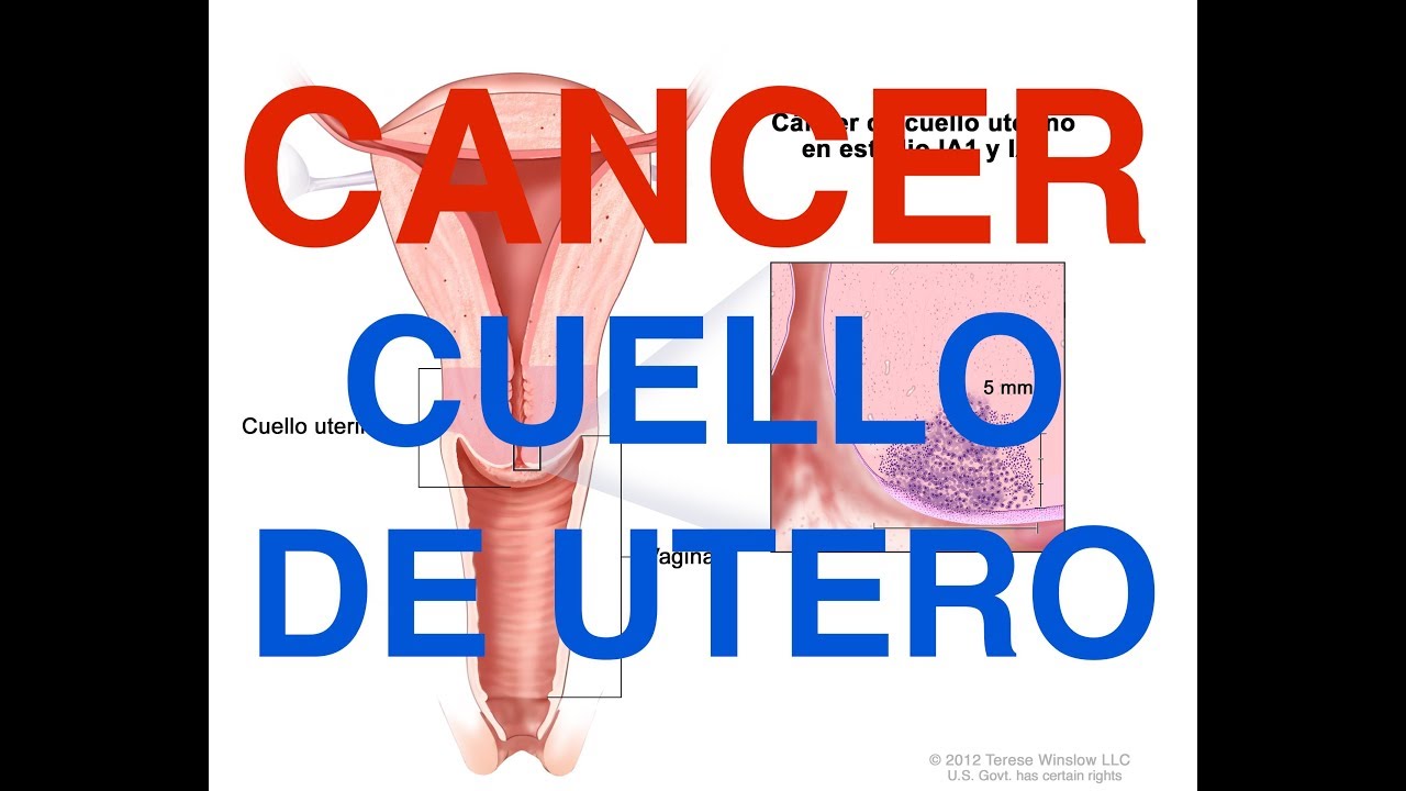 Cancer De Cuello De Utero Como Puede Generarlo Tu Doble Cuantico