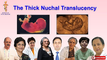 The Thick Nuchal Translucency