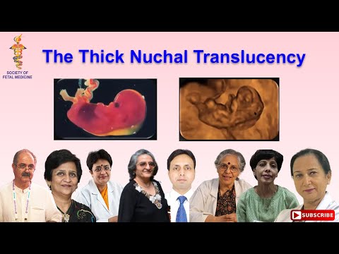 Video: Nuchal translucency txo?
