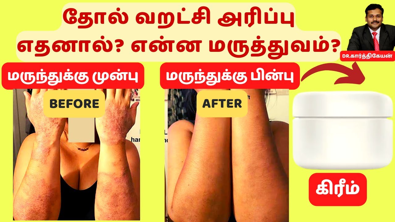 தோல் வறட்சி அரிப்பு நீங்க சூப்பர் மருத்துவம் || skin dryness itching home remedies dr karthikeyan