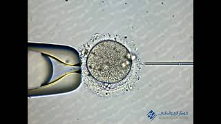 الحقن المجهري  ICSI
