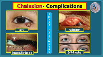 What are the Complications of Chalazion?