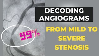 How Your Cardiologist Determines the Degree of Blockage | What is a Severe Stenosis?