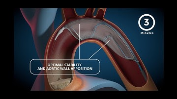 FLOWer - THE EMBOLIC PROTECTION DEVICE WITH CATCH&FLOW TECHNOLOGY