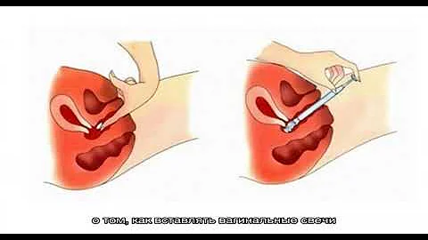 Как вставлять вагинальные свечи