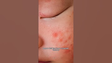 Frequency Separation Technique for Eczema Skin in newborn photo retouch