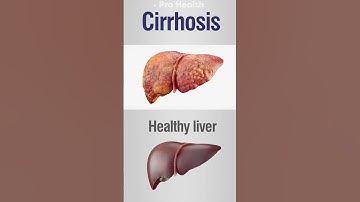 Liver Cirrhosis: Silent Signs You Should Never Ignore! 2025#liverhealth #shorts #short #shortvideo