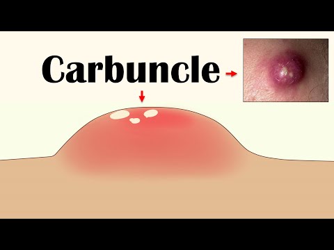 Video: Da li karbunuli zahtijevaju operaciju?