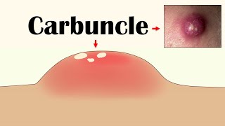 Carbuncle - Causes, Signs & Symptoms, Risk Factors, Diagnosis, & Treatment