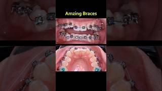 Geweldige beugel - Scheve tanden rechtgezet #beugel #orthodontist #tandarts #tanden