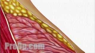 Breast Biopsy Needle Surgery Preop Patient Engagement And Education