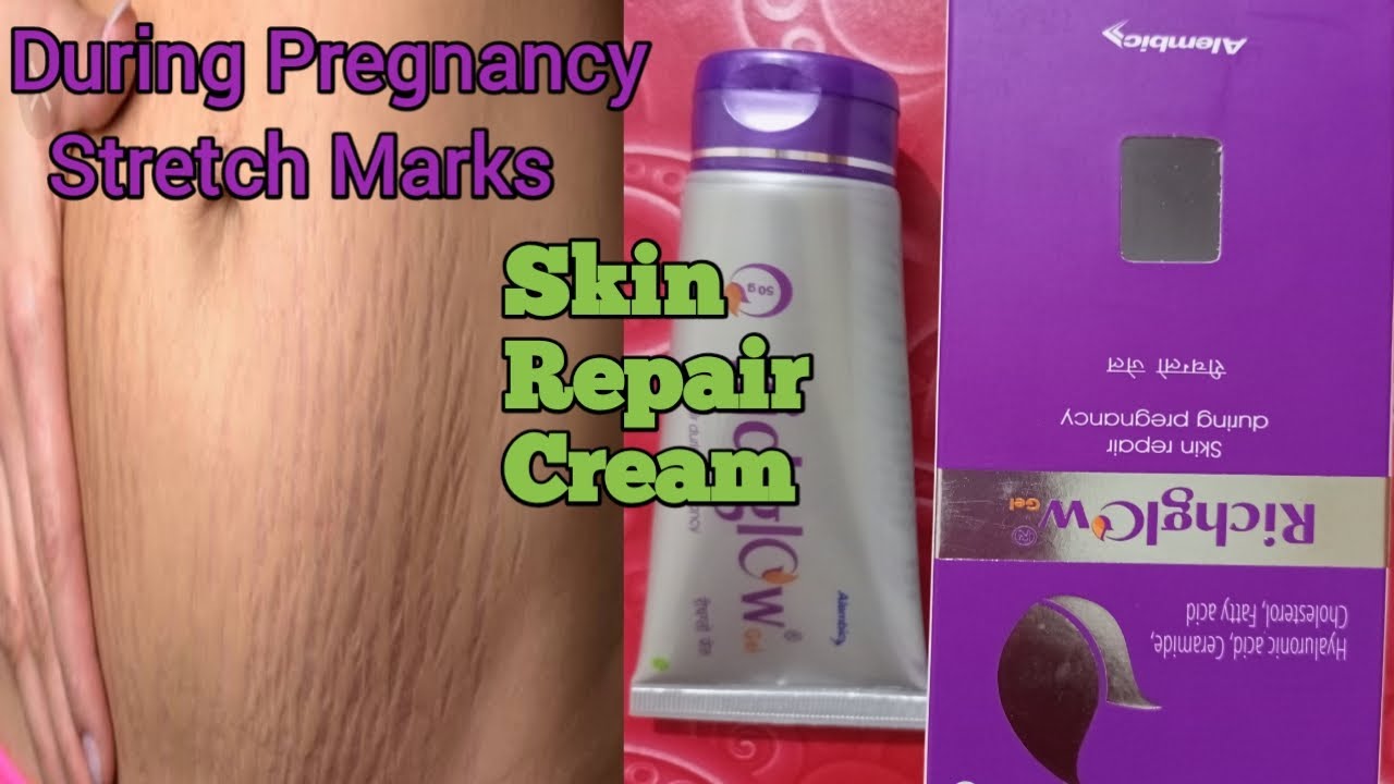 Stretch Marks Removal Guide l Simple Ways To Teat Stretch Marks l Stretch Marks Removal Cream l | NISHA KITCHEN HOME