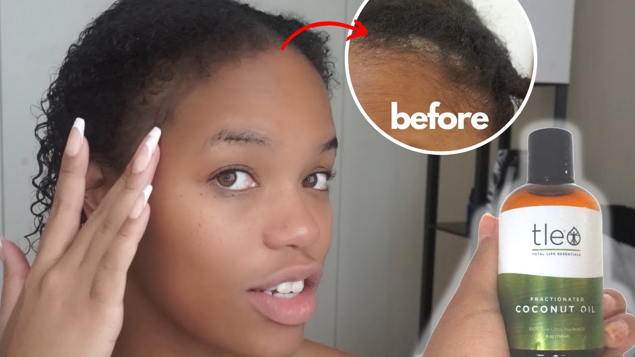 How To Do a Coconut Oil Treatment for Scalp Psoriasis and Dry Scalp