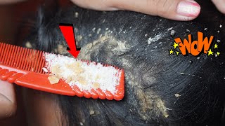 Dandruff Removal, Itchy Scratching, Huge Flakes And Relaxing With Music (Christmas Song) #407
