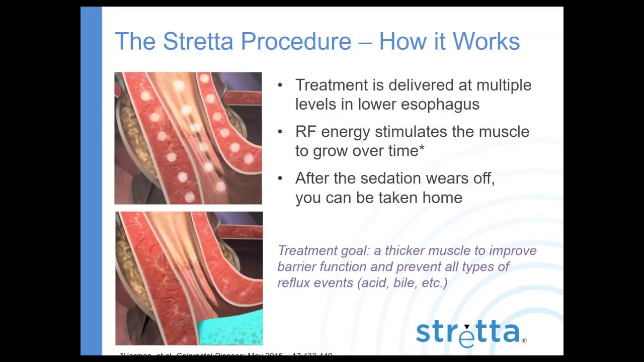 Stretta Patient Webinar 2017 Dr Reiss YouTube