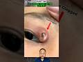 🔥 You Won’t Believe What Causes This Eyelid Bump…#shortsfeed #shorts