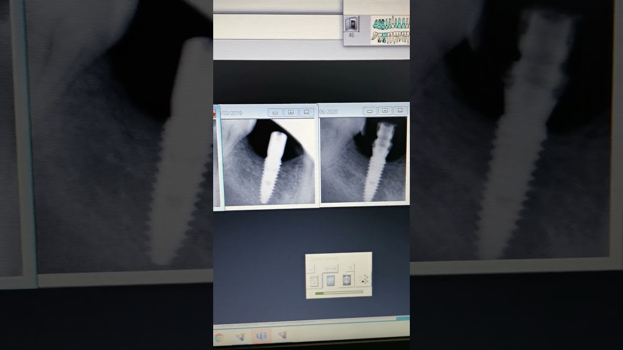 Implantes postextracción  de carga inmediata