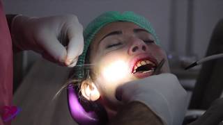 تغطية جراحية للابتسامة اللثوية وقص اللثة - الدكتور محمد الدالي أخصائي الجراحة و أمراض اللثة