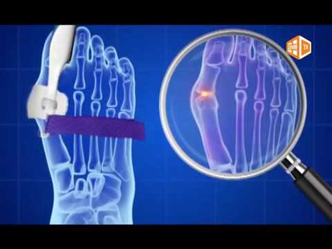 Ортопедический корректирующий фиксатор для стопы «Красивые пальчики» shishkanogi.ru