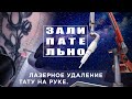 ЛАЗЕРНОЕ УДАЛЕНИЕ ТАТУ НА РУКЕ. КЛИНИКА "ET.LASER" Москва