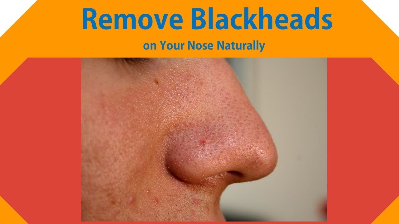 How to Remove Blackheads on Your Nose Using Natural Home Remedies