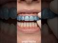 Deep Bite Correction 😱 Blue Aligner Slowly Fixes Uneven Teeth