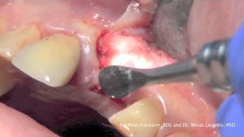 EthOss® Anterior Case