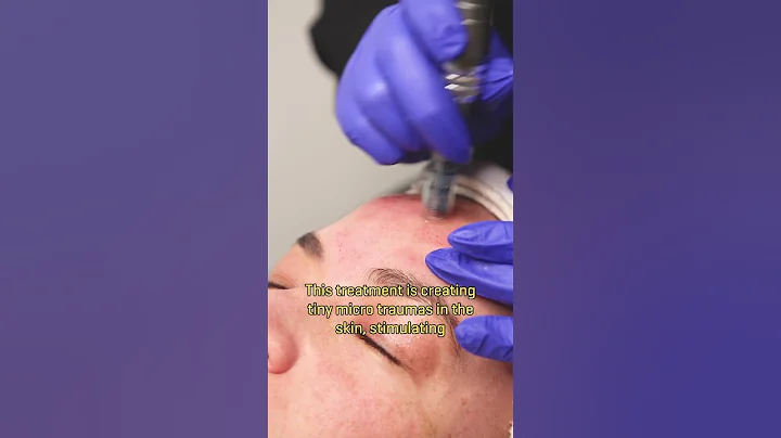 How's a Micro Needling Skin Treatment? #microneedling