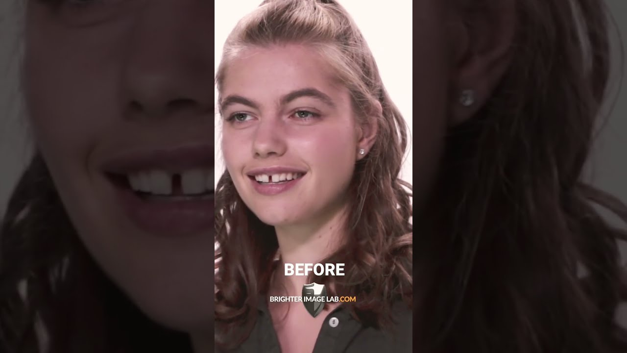 IncrediBIL Smile Makeover #shorts