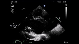 Left Ventricular Compression By a Thoracic Aortic Aneurysm