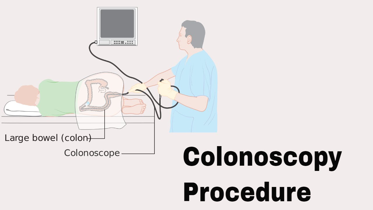 Colonoscopy Procedure || Coloniscopy Biopsy || How to Perform