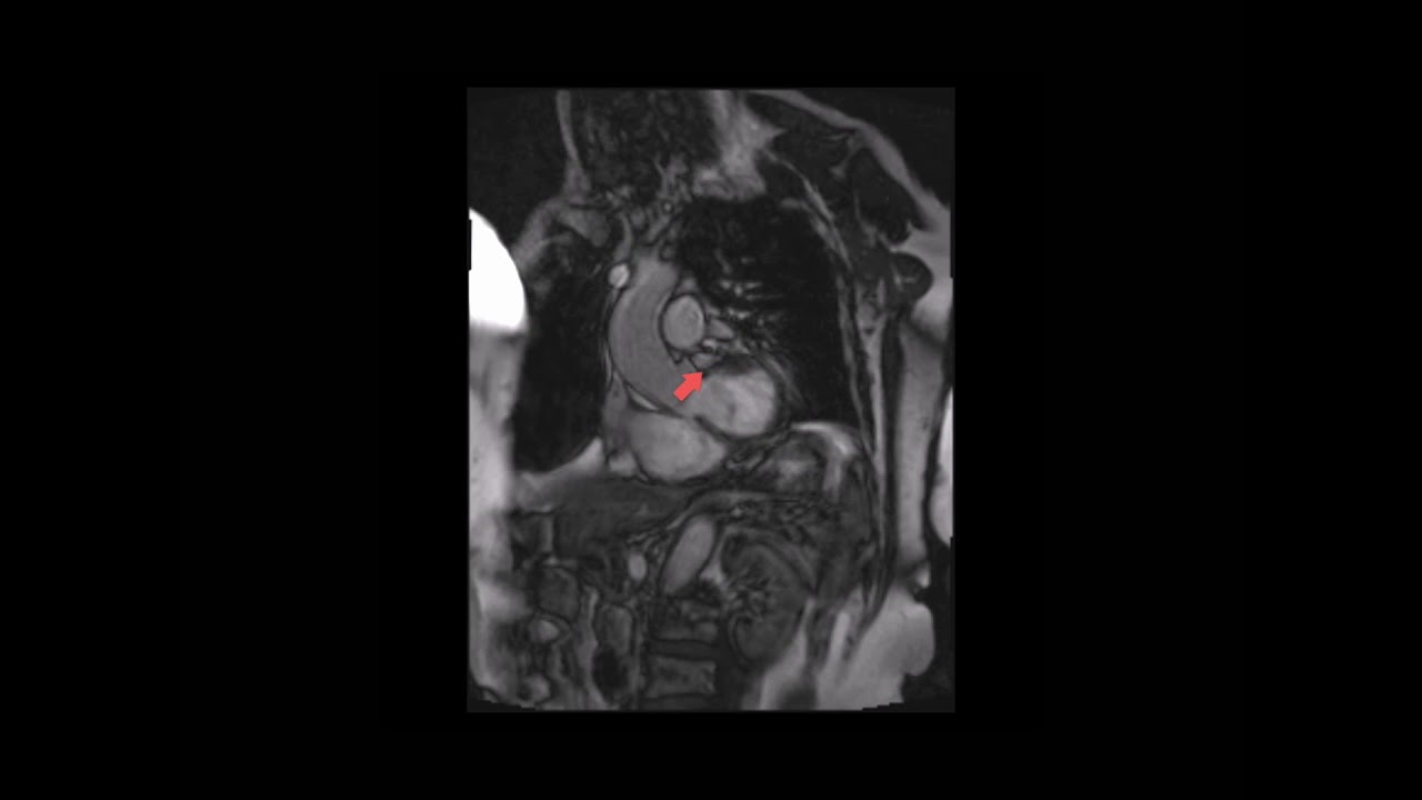 How to assess aortic stenosis using CMR