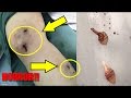 Maggots Burst Out Of Chinese Backpacker’s Leg Weeks After Brazilian Rainforest Trip
