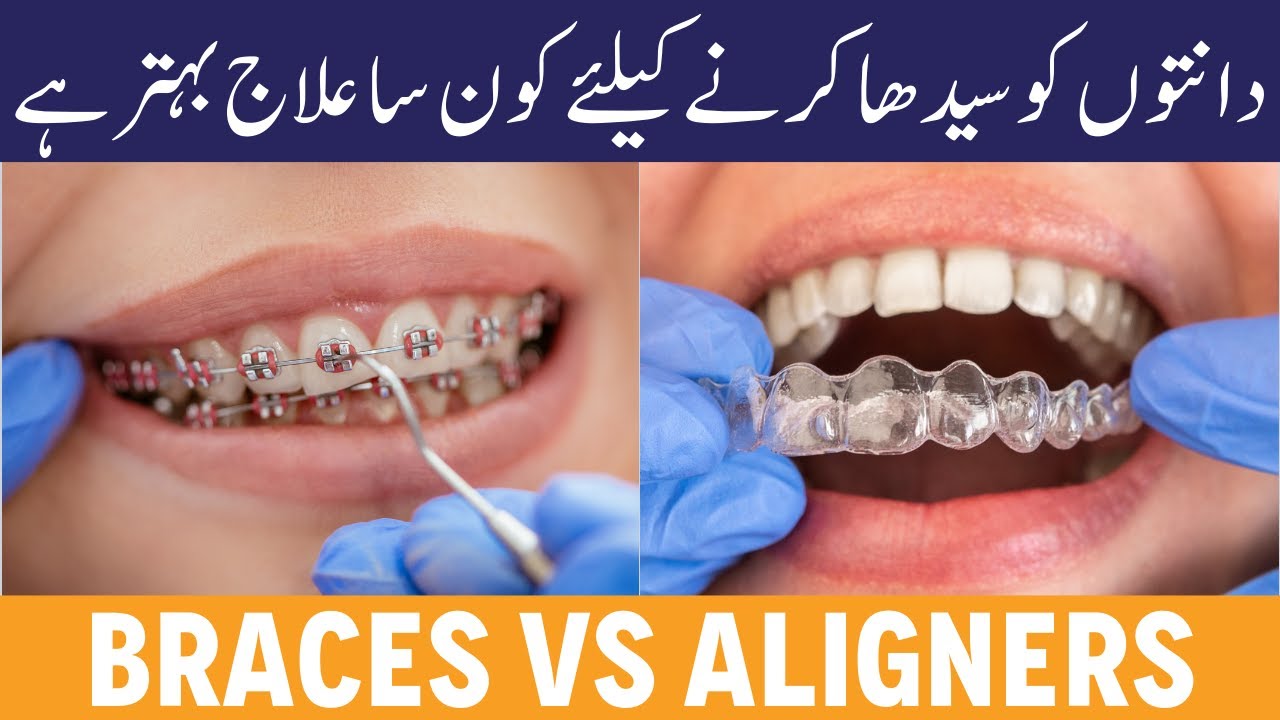 FIXED BRACES Vs ALIGNERS Braces Lagana Se Kya Hota Hai Aligners fixed-braces-vs-aligners-braces-lagana-se-kya-hota-hai-aligners