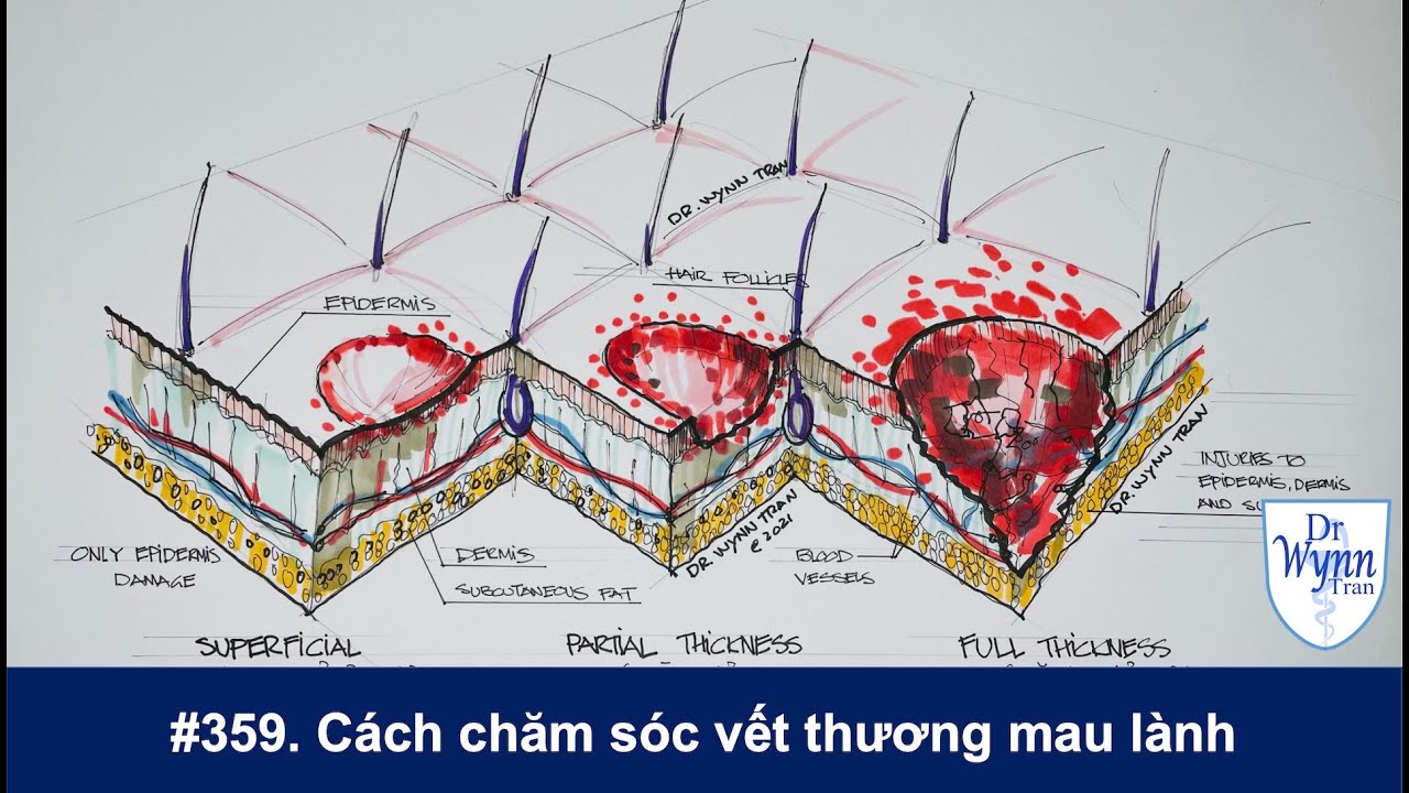 Chăm sóc vết thương: Không dùng oxy già (hydrogen peroxide)