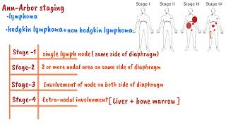 Ann Arbor staging system for Lymphoma | Oncology  Staging Ann Arbor