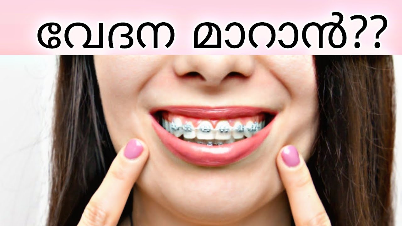 വേദന മാറാൻ / pallil kambi idunnath malayalam / pallil kambi / braces