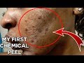 CHEMICAL PEEL | MY FIRST CHEMICAL PEEL | BEFORE & AFTER  | KENSTHETIC