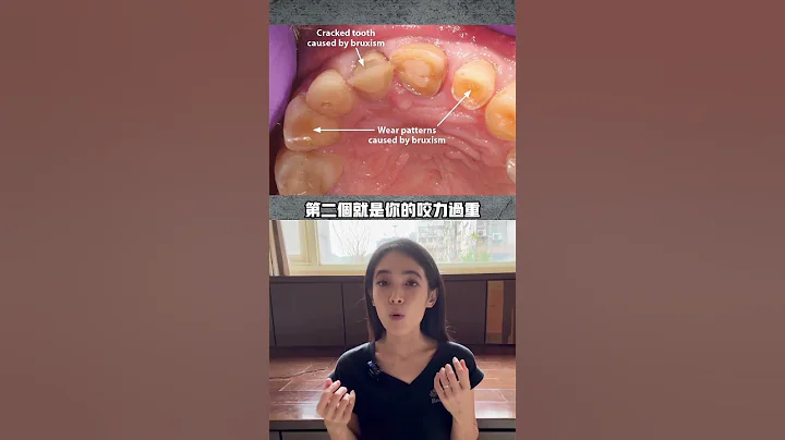 补牙容易掉的两个原因#树脂补牙#齿雕补牙#磨牙 - 天天要闻