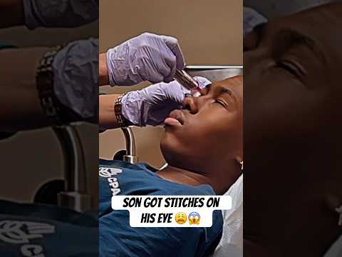 Dad watches Son got stitches on eye 😱😩 #viral #shorts #fyp #family