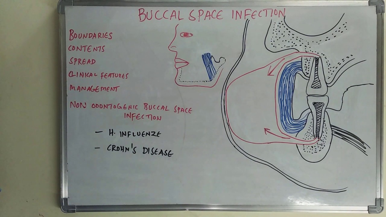 Buccal space infection YouTube